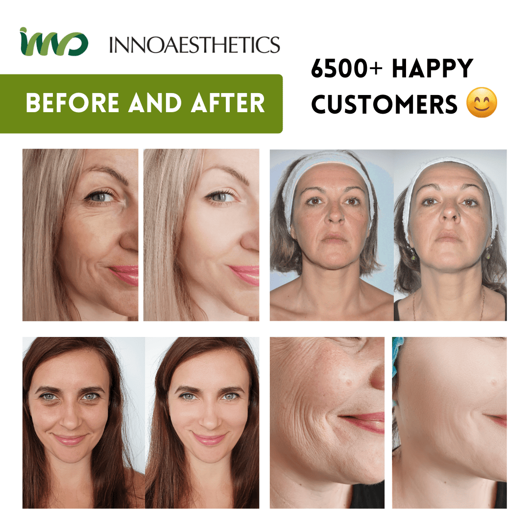 INNO-EXFO® Lightening Peel