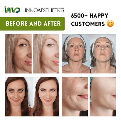 INNO-EXFO® Lightening Peel